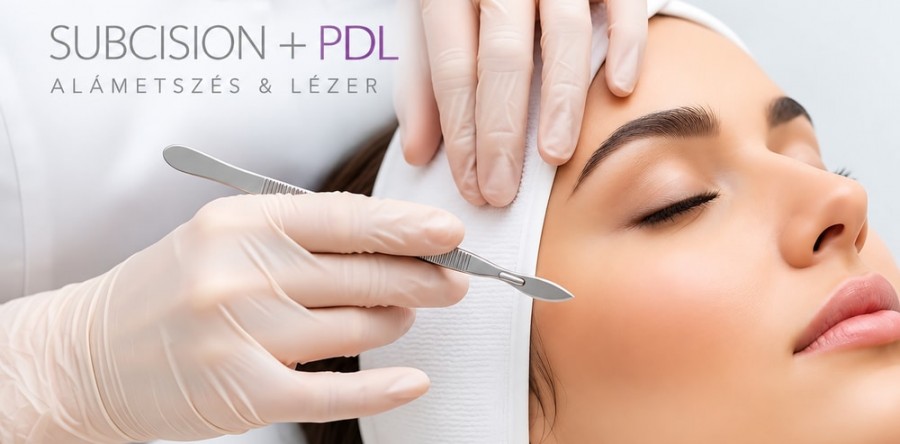 Alámetszés (subcision + PDL) aknés hegre