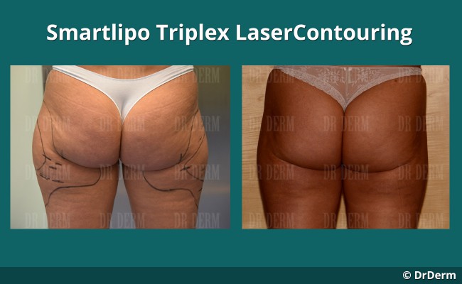 lasercontouring_new_1_1