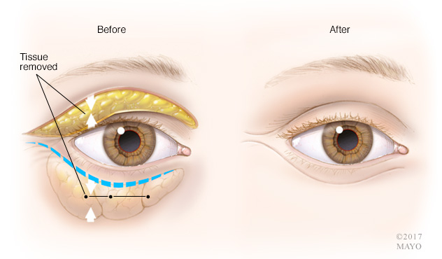 eyelidsurgery