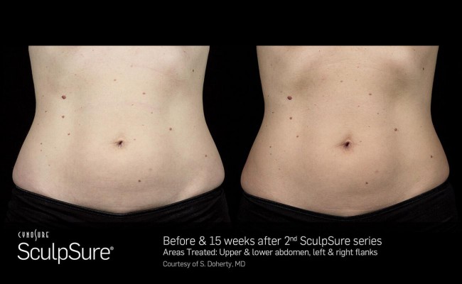 sculpsure_10_resized