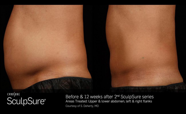 sculpsure_12_resized