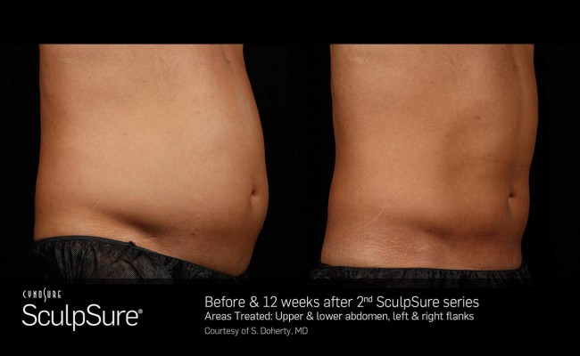 sculpsure_13_resized