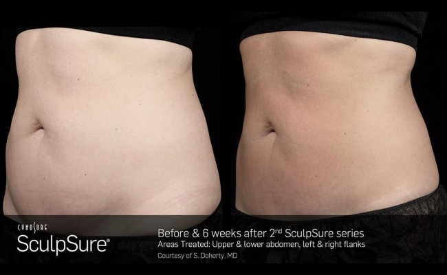 sculpsure_15_resized