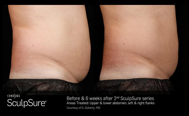 sculpsure_16_resized