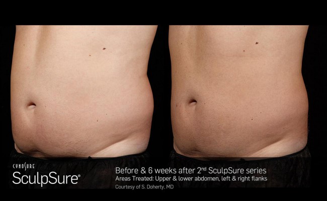 sculpsure_17_resized