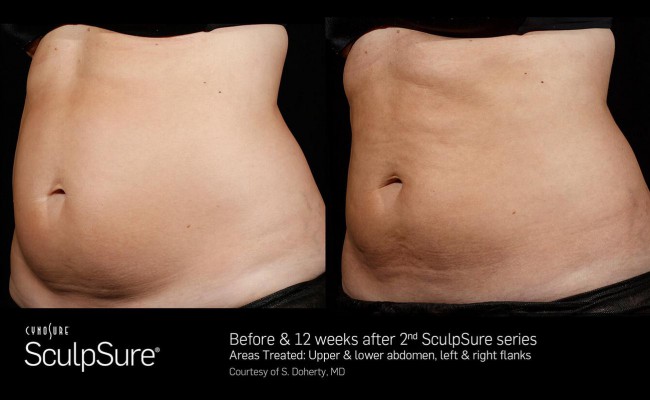 sculpsure_18_resized