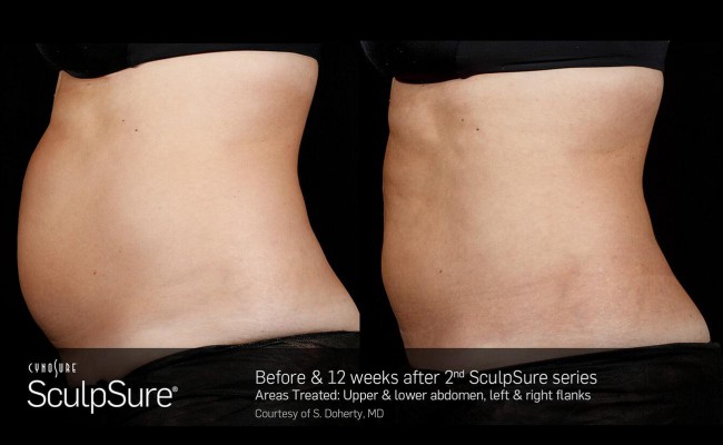 sculpsure_19_resized