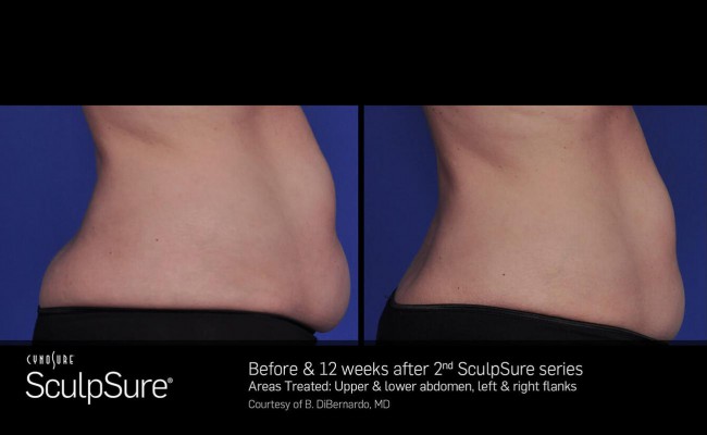 sculpsure_1_resized