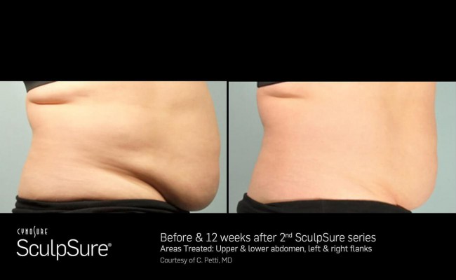 sculpsure_2_resized