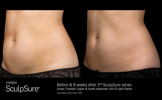 sculpsure_3_resized