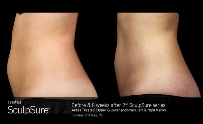 sculpsure_4_resized
