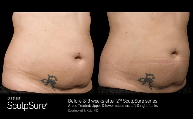sculpsure_5_resized