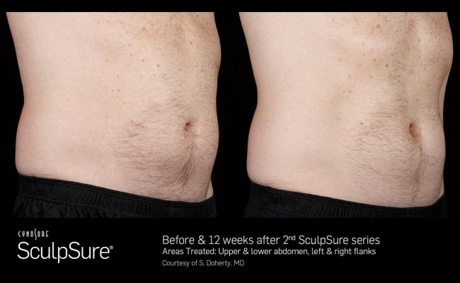 sculpsure_9_resized