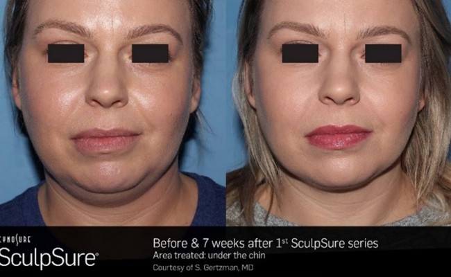 sculpsure_submental_1