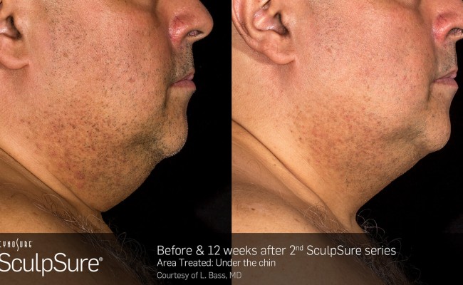 sculpsure_submental_3