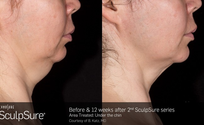 sculpsure_submental_4