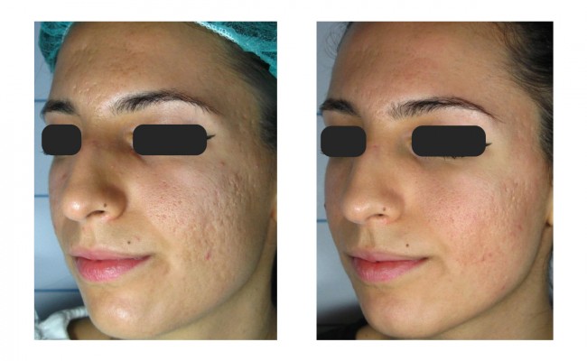 RedTouch kollagén kezelés arcbőr feszesítéssel