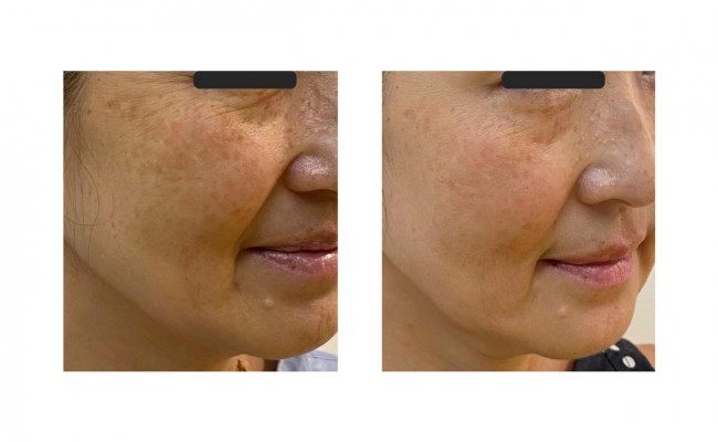 anti aging bőr kezelések felülvizsgálata