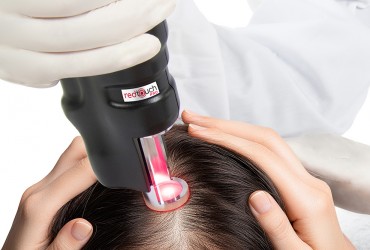 Lézeres biostimuláció androgén alopéciában
