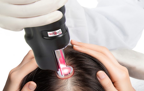 Lézeres biostimuláció androgén alopéciában