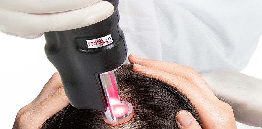 Lézeres biostimuláció androgén alopéciában