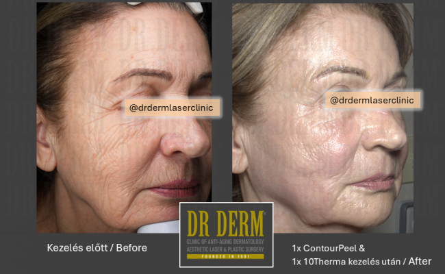 10Therma_Dr Derm Budapest 1