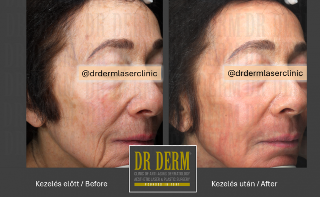 ContourPeel_Dr Derm Budapest 1