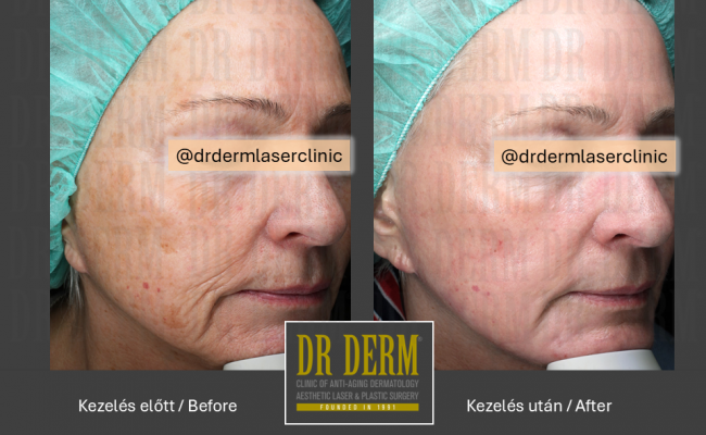 ContourPeel_Dr Derm Budapest 2_1
