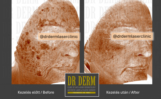 ContourPeel_Dr Derm Budapest 3