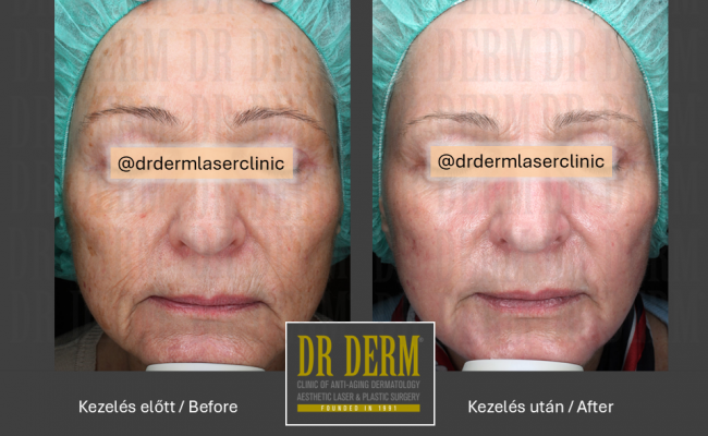 ContourPeel_Dr Derm Budapest 4_1