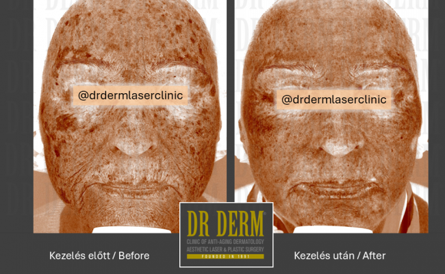 ContourPeel_Dr Derm Budapest 5