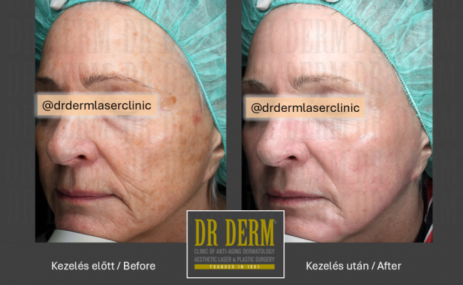 ContourPeel_Dr Derm Budapest 6