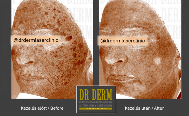ContourPeel_Dr Derm Budapest 7