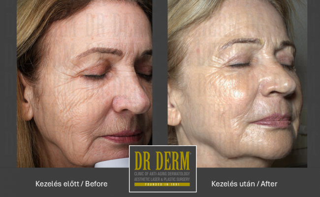 ContourPeel_Dr Derm Budapest 8