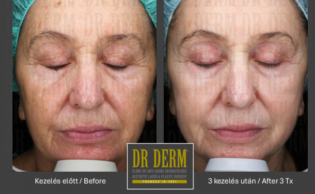 DOT frakcionalt CO2_Dr Derm Budapest 1