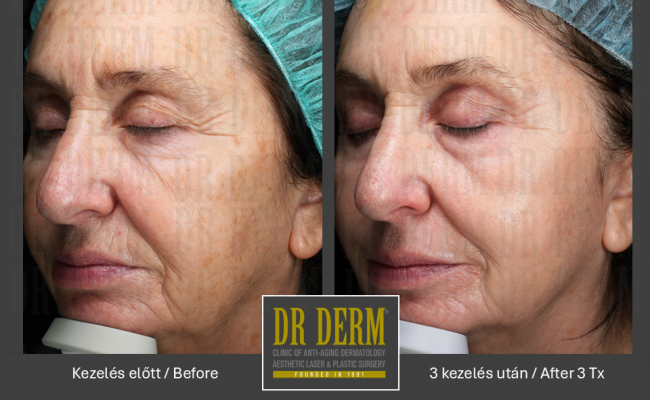 DOT frakcionalt CO2_Dr Derm Budapest 2