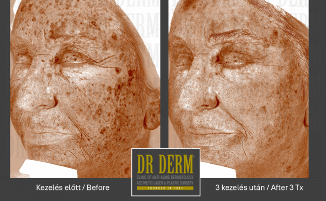 DOT frakcionalt CO2_Dr Derm Budapest 3