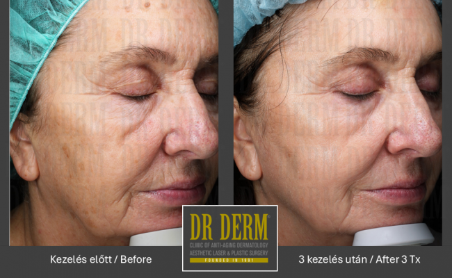 DOT frakcionalt CO2_Dr Derm Budapest 4
