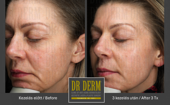DOT frakcionalt CO2_Dr Derm Budapest 5