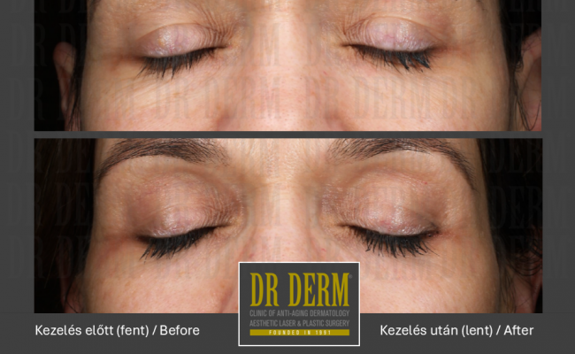 DOT szemhéj_Dr Derm Budapest 1