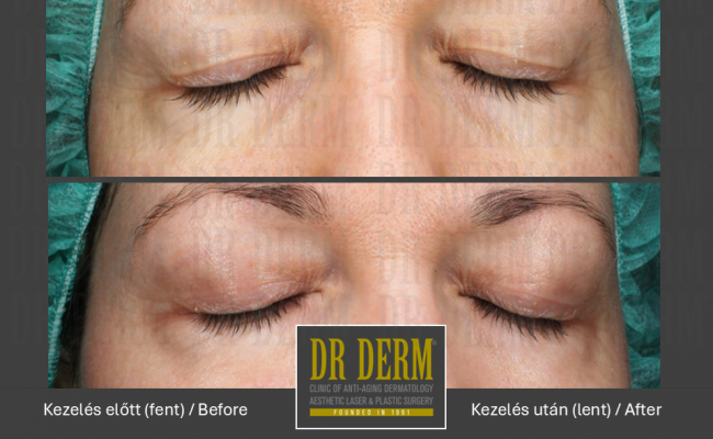 DOT szemhéj_Dr Derm Budapest 2
