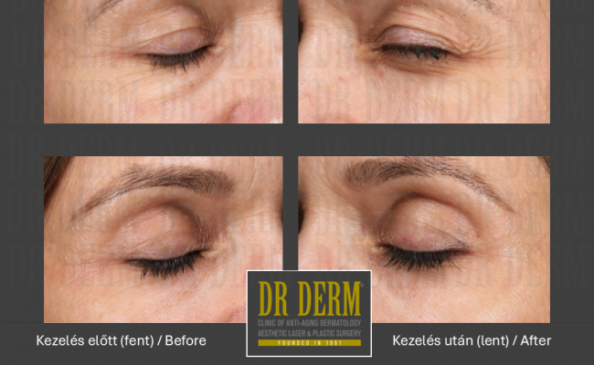 DOT szemhéj_Dr Derm Budapest 3