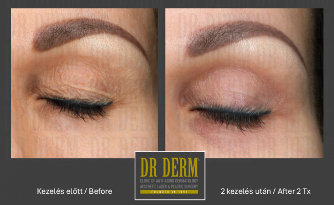 DOT szemhéj_Dr Derm Budapest 4