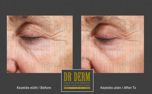 DOT szemhéj_Dr Derm Budapest 5