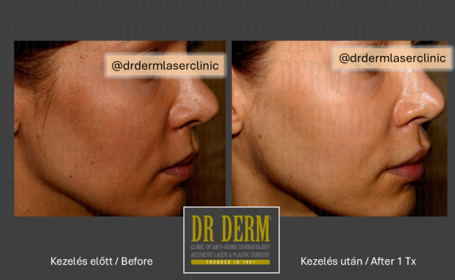 HALO hybrid laser_Dr Derm 1