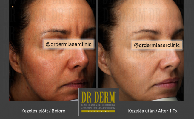 HALO hybrid laser_Dr Derm 2