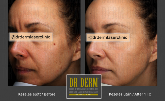 HALO hybrid laser_Dr Derm 3