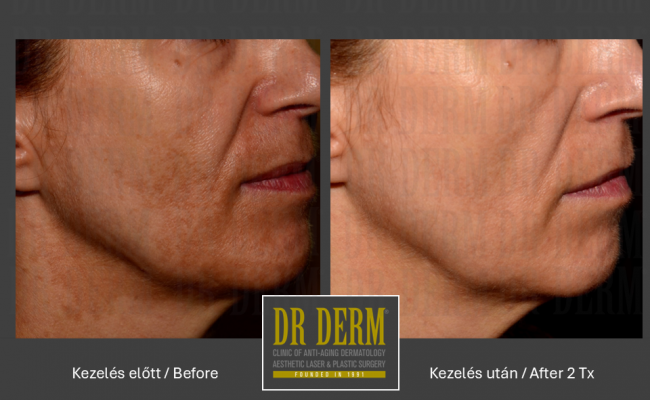 HALO hybrid laser_Dr Derm 4