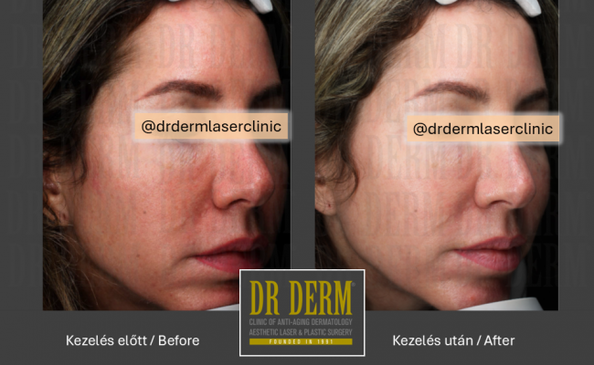 HALO hybrid laser_Dr Derm 5