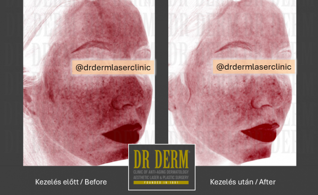HALO hybrid laser_Dr Derm 6